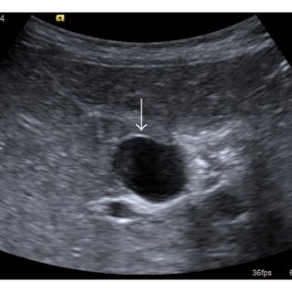 Ultrasound image of the cystic duct cyst: (a) the cystic duct cyst at ...