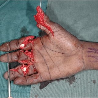 mangled hand