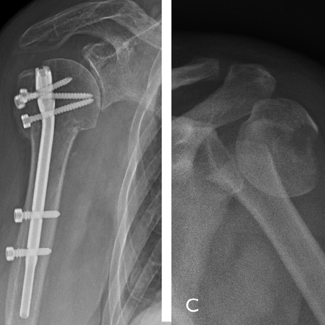Proximal Humeral Fractures With A Severe Varus Deformity Treated By ...