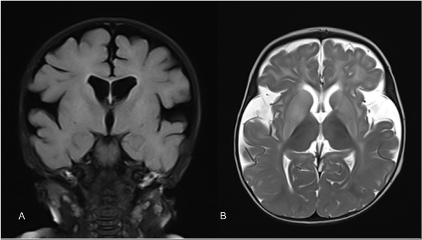 (A and B) MRI brain coronal T1 and axial T2-weighted images showing widening of sylvian fissures and open opercula