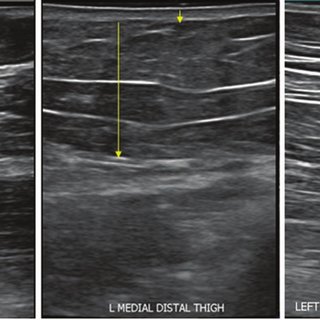 Example of clinical images of patients with lipedema (top) and