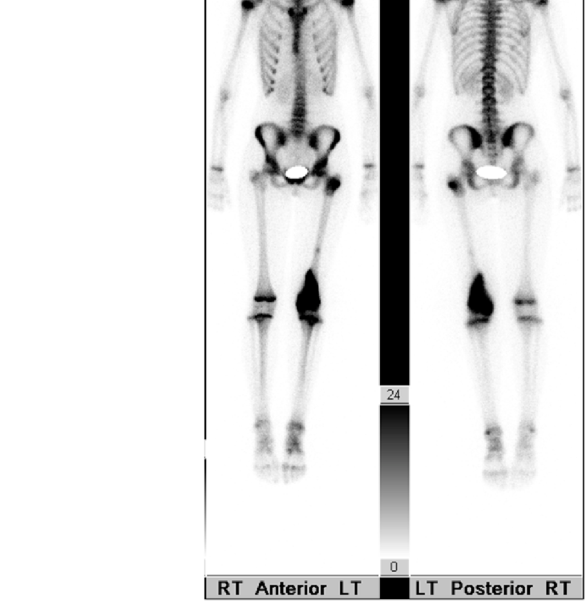 Whole body technetium bone scan of the patient in Fig. 5, demonstrating osteosarcoma skip lesions within the left femur  