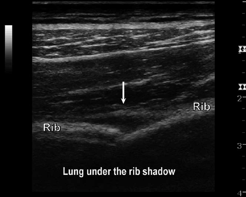 Rib Fracture Ultrasound