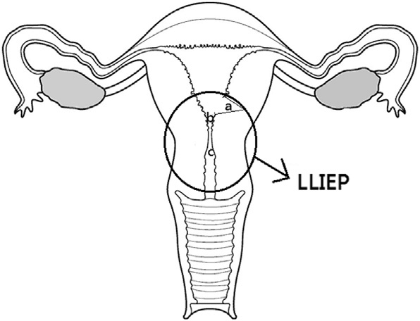 The circled area with the letters a, b, and c inside indicate various low-lying-implantation ectopic pregnancy (LLIEP) anatomic locations: a ¼ cesarean scar pregnancy; b ¼ cervical-isthmus pregnancy; c ¼ cervical pregnancy. 
