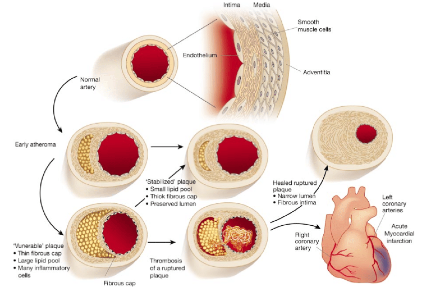 1 A depiction of the progression of atherosclerosis, showing the