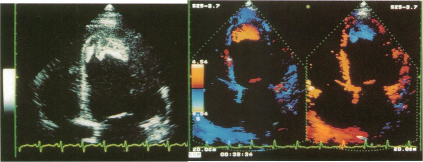 Apical images of a left ventricular apical thrombus (conventional grey scale, left; TDE, right) showing the improved identification of structures by TDE. The direction of motion ofthe thrombus (colour codedyelow) is opposite to that of the adjacent myocardium (colour coded blue). 