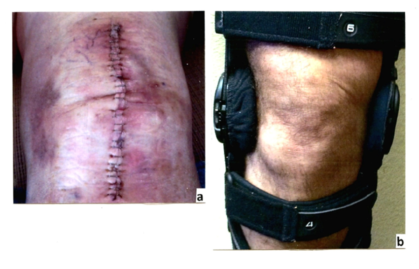 Comparison Of Knee Appearance After Total Knee Replacement