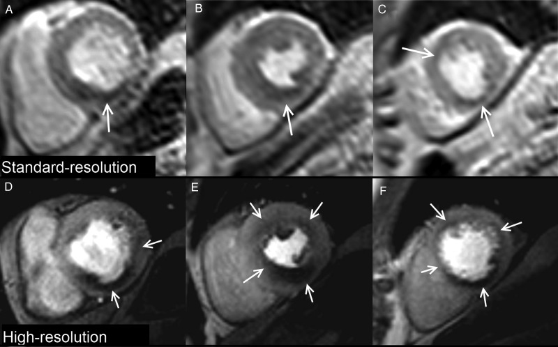 Case example. Standard and high-resolution stress perfusion CMR in a patient with three-vessel coronary artery disease. Standard-resolution shows perfusion defects (arrows) in the basal-inferior (A), mid-inferior, mid-inferoseptal (B), apical-anterior and apical-inferior segments (C). High-resolution shows a similar distribution of perfusion defects but demonstrates additional ischaemia in the basal-lateral (D), mid-anterior, and mid-anterolateral segments (E) with a circumferential defect in the apical slice (F). Perfusion defects are also better delineated at high-resolution and the transmural extent of ischaemia more clearly seen.
