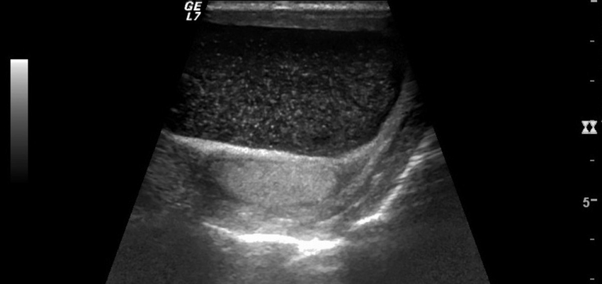 Hydrocele : an anechoic fluid collection within the scrotal sac, with internal lowlevel echoes, indicating a high protein or cholesterol content. 