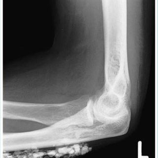 - Isolated left elbow subcutaneous mass (arrows). | Download Scientific ...