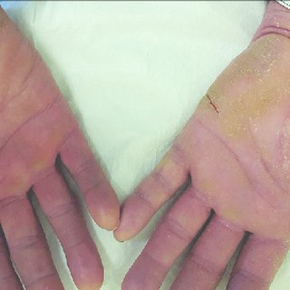 Brown Skin Matters on X: The fungal infection tinea manuum, compared. And  thanks to all for all of the suggestions on my last post. I am pursuing  several potentially fruitful partnerships.  /