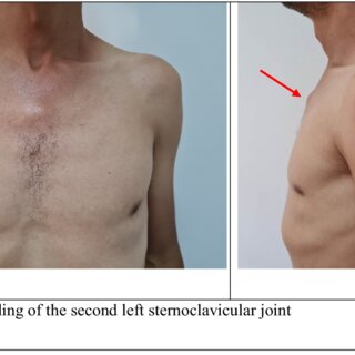 Photo a, b. Swelling of the second left sternoclavicular joint.