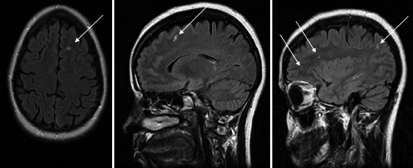 The Link Between Migraines And Brain Lesions