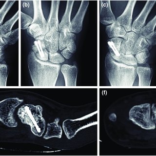 (PDF) Single versus double screw fixation for the treatment of scaphoid ...