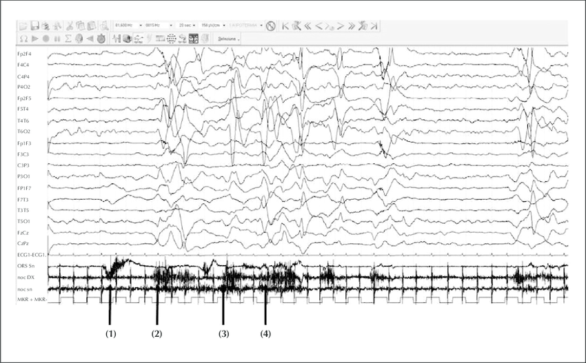Scalp Eeg Recording Of Patient 10 During Dyskinetic Movements Of The Download Scientific