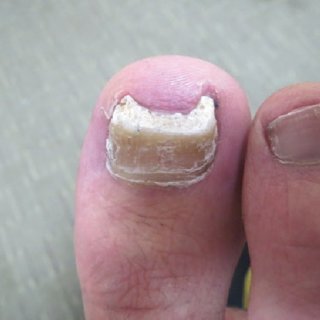 (PDF) Grading Onychomycosis: Diagnosis and Effective Management