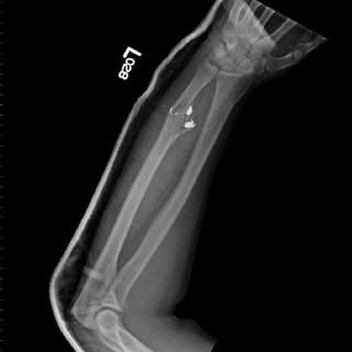 A Anteroposterior radiograph of a gunshot fracture of the humerus ...