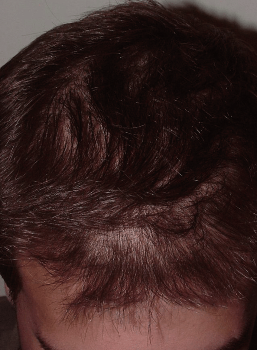 -Androgenetic alopecia in a 12-year-old boy.