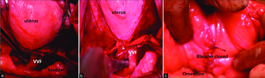 (a) The bladder is bivalved which shows the fistula communication. (b) The tip of suction is introduced into the vesicovaginal fistula. (c) The bladder is closed vertically and omentum is interposed between bladder and vagina