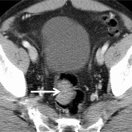 Rectal Kaposi’s sarcoma in a 29-year-old HIV-positive man. a Axial, b ...