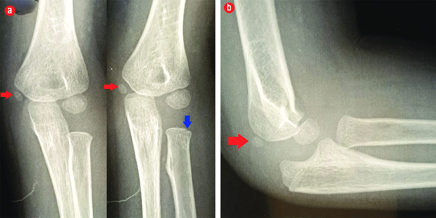 Left Elbow Radiographs A Two Anterior Posterior Projections Of The