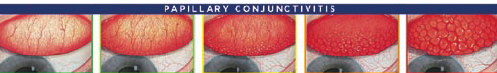 Efron pictorial papillary hyperaemia grading scale (Efron ...