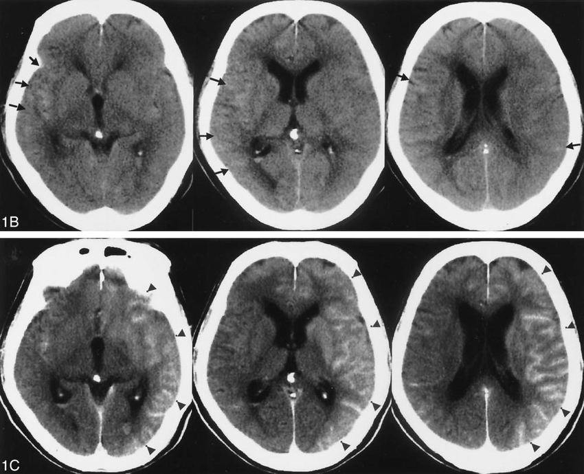 A 72 Year Old Man Presented With Subarachnoid Hemorrhage Secondary To A Download Scientific Diagram