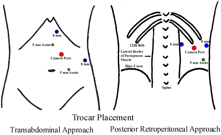 Port placement. a Transabdominal approach; b posterior retroperitoneal approach
