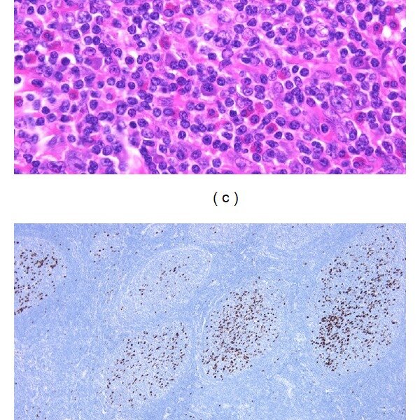Igg4 Related Lymphadenopathy Type I A The Lymph Node Shows Download Scientific Diagram