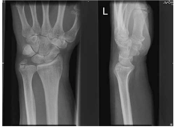 styloid process of ulna fracture