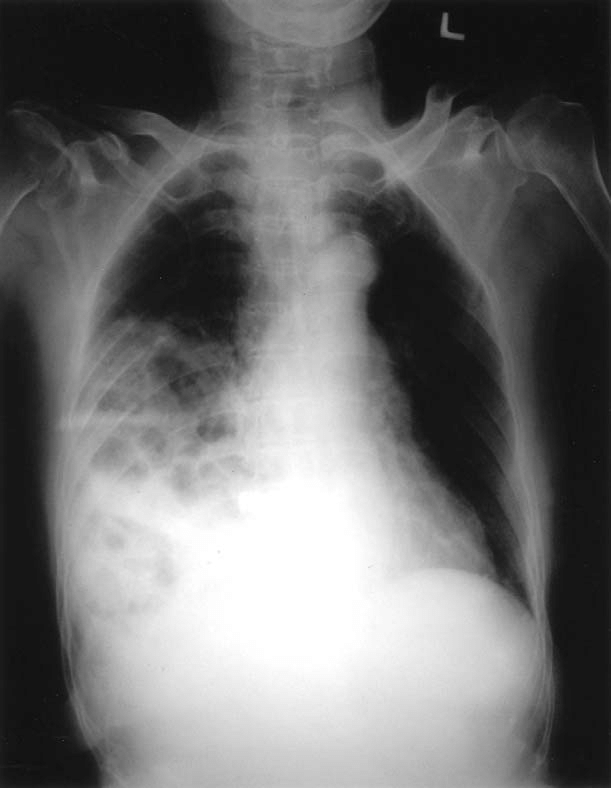 Chest X-ray of Case 2 shows a hyperdense lesion containing bowel gas in the right pleural space.
