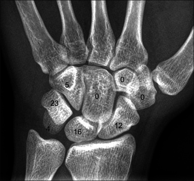 The distribution of carpal bone fractures that occurred 