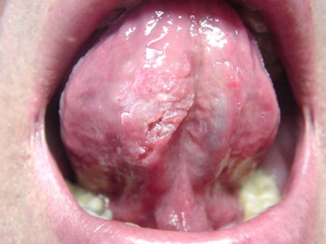squamous cell carcinoma tongue