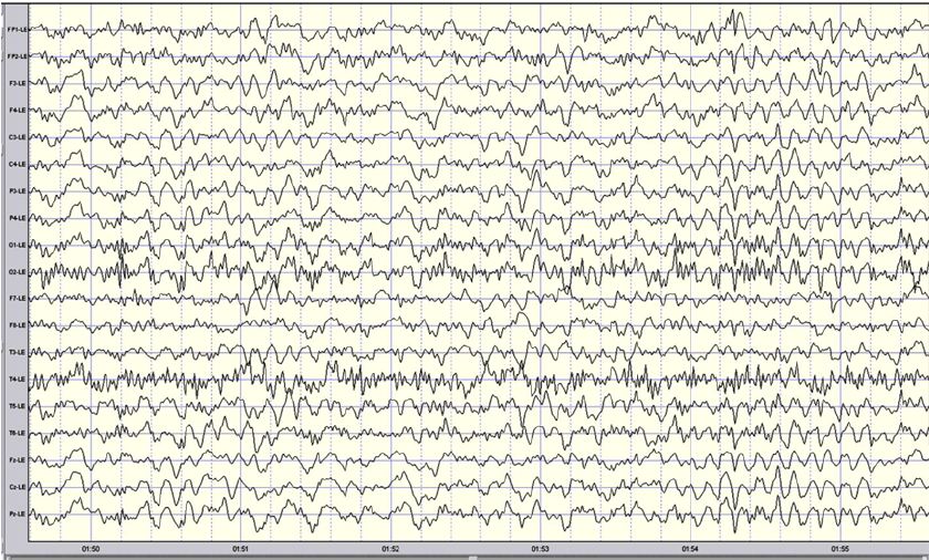 Six s of raw EEG tracings for the eyes-opened recording. The 
