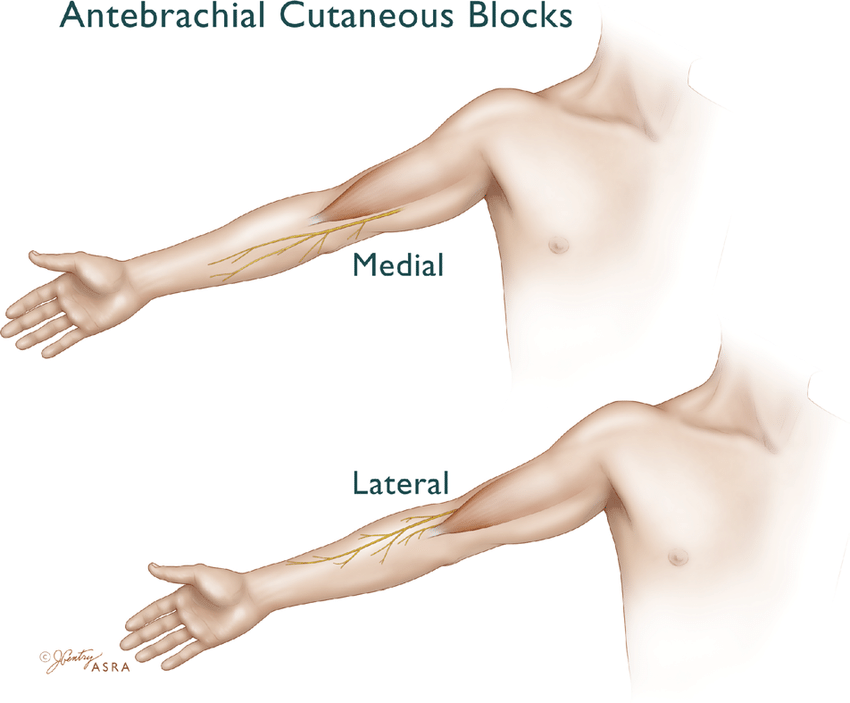Medial And Lateral Antebrachial Cutaneous Nerve Blocks The Medial