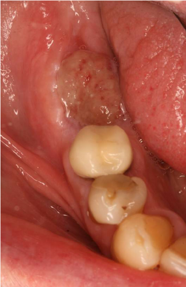 Granulation Tissue On Tooth Extraction - Tissue Photos and ...