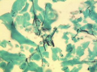 A photomicrograph showing budding yeast and pseudohyphae consistent with Candida spieces and inflammatory debris within the mesh. (Silver methenamine stain, original magnification 400×.)