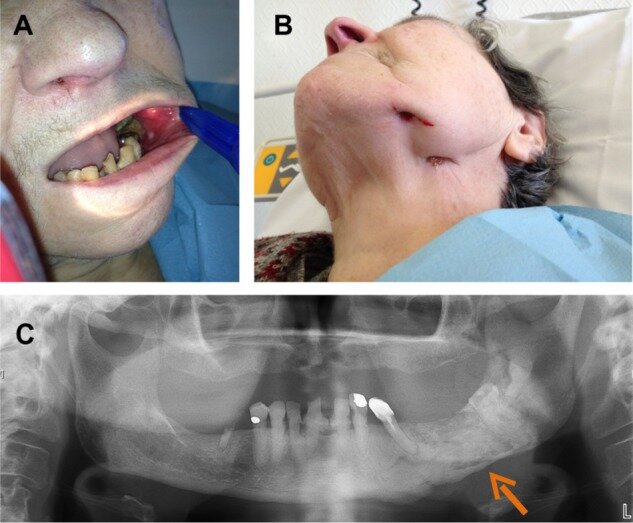 osteomyelitis jaw after wisdom teeth extraction