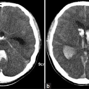 A non-contrast computed tomography scan demonstrates acute large ...