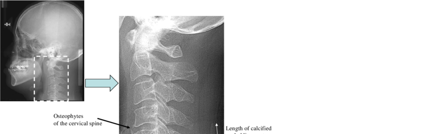 ligamentum nuchae calcification