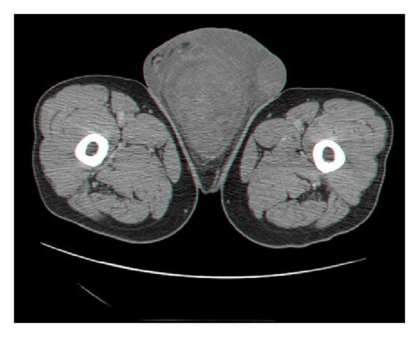 Ct Scan Of The Perineum Showing A Median Scrotal Mass Download Scientific Diagram