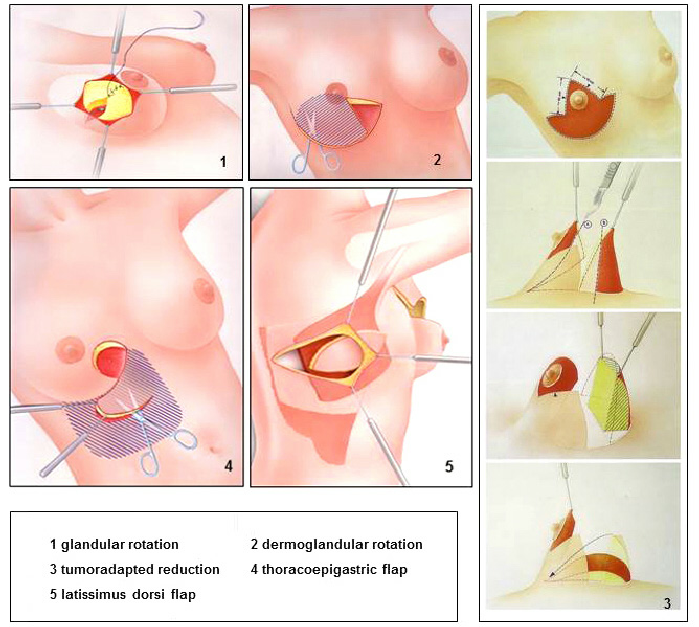 Oncoplastic breast-conserving surgery: five principles of