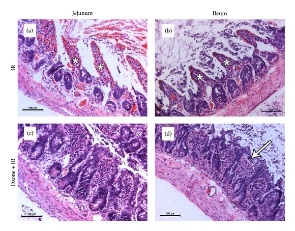 Effect of ischemia reperfusion and ozone pretreatment to ischemia reperfusion in jejunum and ileum (stained with hematoxylin-eosin, magnification ×200). Desquamation of the epithelium and denuded villi (asteriks) in both jejenum (a) and ileum (b) of IR group. Shortened and thick villi in both jejenum (c) and ileum (d) of ozone pretreated IR group. A less marked subepithelial space (arrow) at the villus tip in ileum.