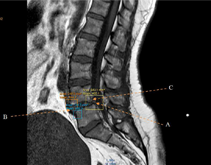 osteophyte formation lumbar spine