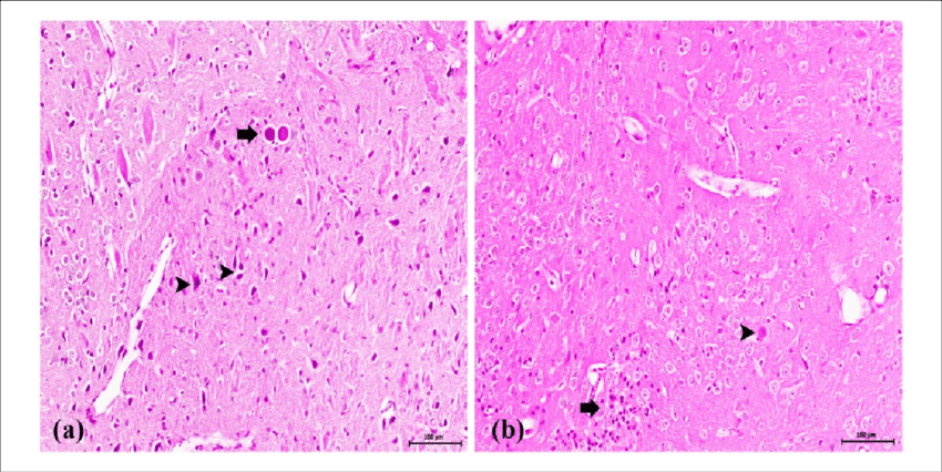 toxoplasmosis brain pathology