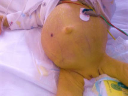 Icterus, ascites, and umbilical hernia in a child with idiopathic