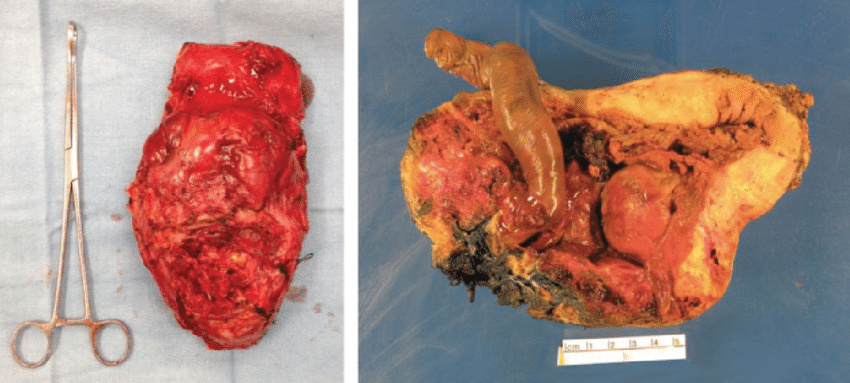 retained placental fragments