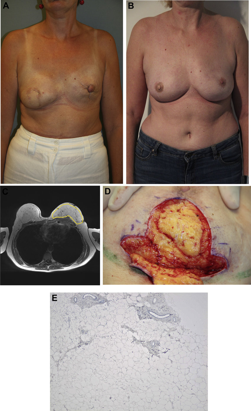 Breast Reconstruction: Patient 3; Before and 1 Month After