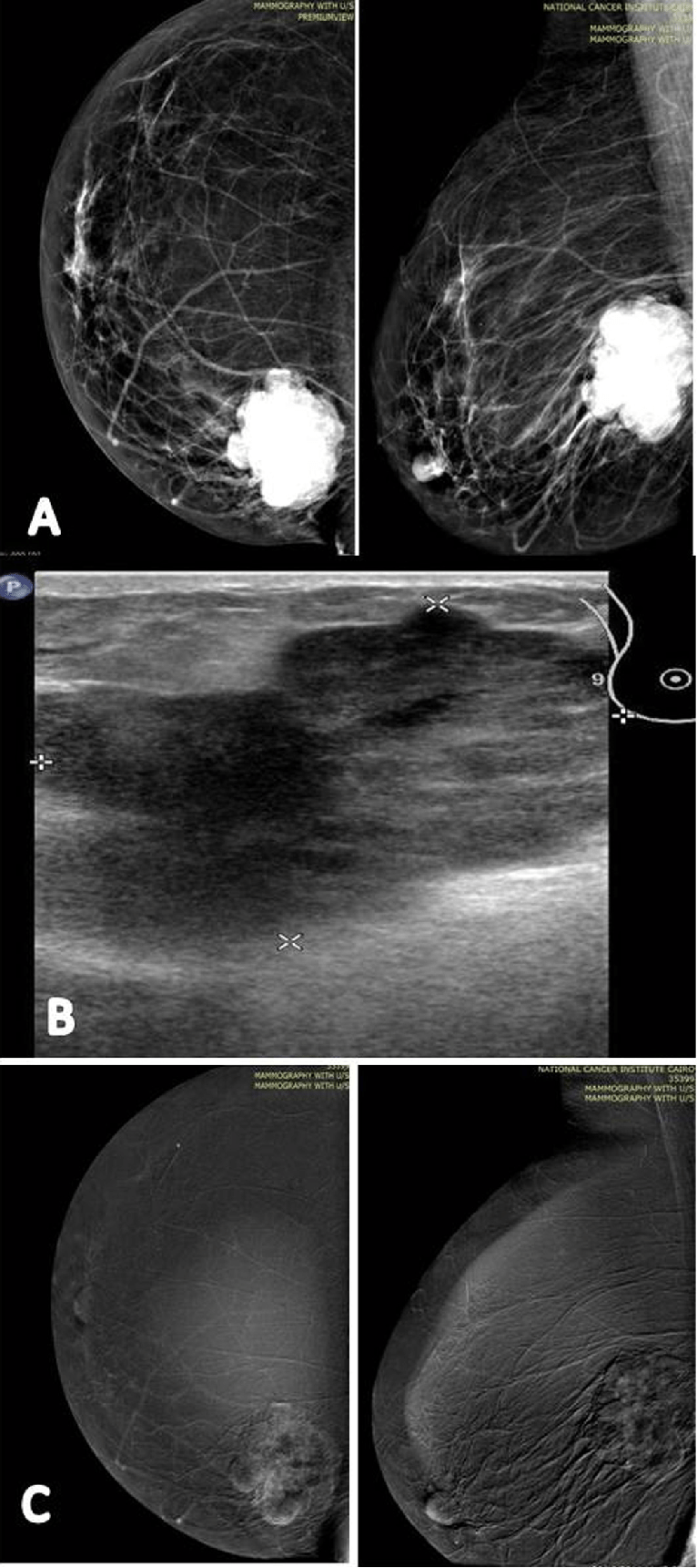 A 60-year-old patient presented by a lump in the left breast.