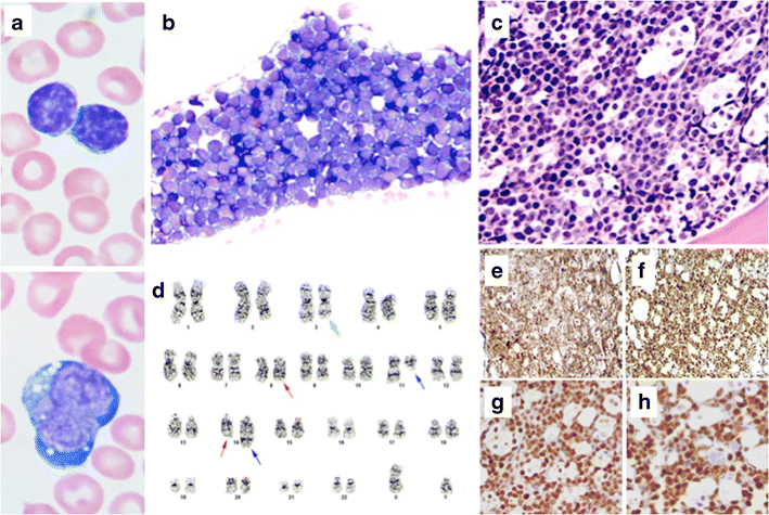 Leukemic Mantle Cell Lymphoma Transformed To Blastoid Variant With Myc Download Scientific Diagram